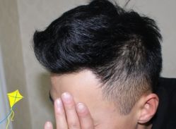 -大麦微针植发丨全国连锁