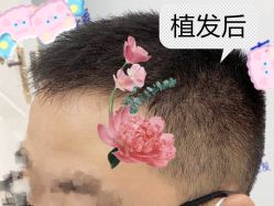-大麦微针植发全国连锁
