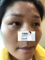 -爱莎扁平疣·汗管瘤·斑痣中心