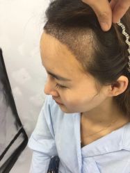 -大麦微针植发丨全国连锁