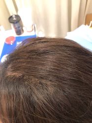 点击看大图 体验前-碧莲盛·不剃发植发