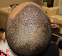 -大麦微针植发丨全国连锁