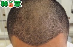 -大麦微针植发丨全国连锁