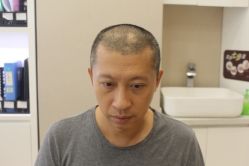 -大麦微针植发丨全国连锁