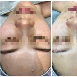 -倩极·精研痘敏肌管理