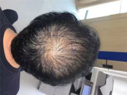 体验前-大麦微针植发全国连锁