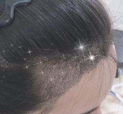 -大麦微针植发全国连锁