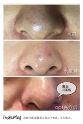 光SPA水氧+opt-光SPA科技美肤