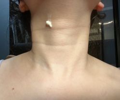 体验前-深圳米兰柏羽医疗美容医院