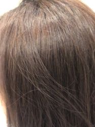 点击看大图 -碧莲盛·不剃发植发
