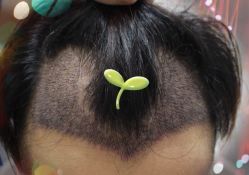 -大麦微针植发全国连锁