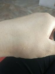 -痣清宫祛斑祛痣连锁店