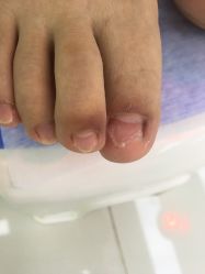 点击看大图 -派恩宜灰指甲鸡眼嵌甲手足癣