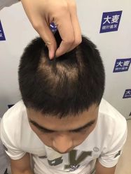点击看大图 -大麦微针植发丨全国连锁