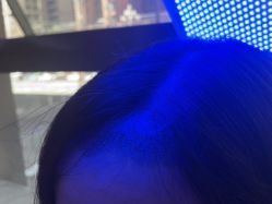 -碧莲盛·不剃发植发