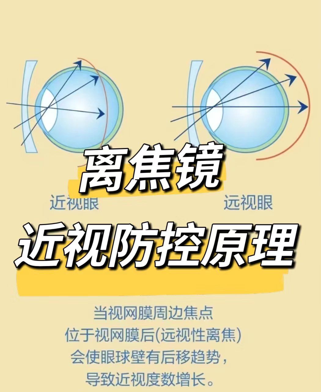 离焦眼镜近视防控原理