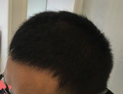-大麦微针植发丨全国连锁