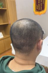 体验后-大麦微针植发全国连锁