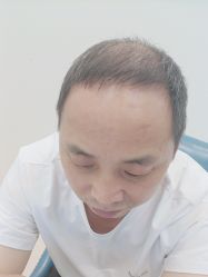 -大麦微针植发丨全国连锁