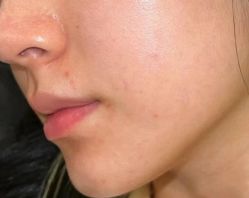 体验前-杭州米兰柏羽医疗美容医院