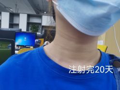 点击看大图 体验后-泉州欧菲医疗美容
