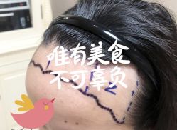 -大麦微针植发全国连锁