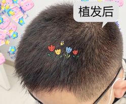 -大麦微针植发全国连锁