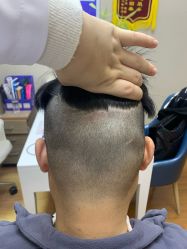 -大麦微针植发全国连锁