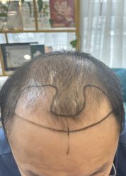 -碧莲盛·不剃发植发