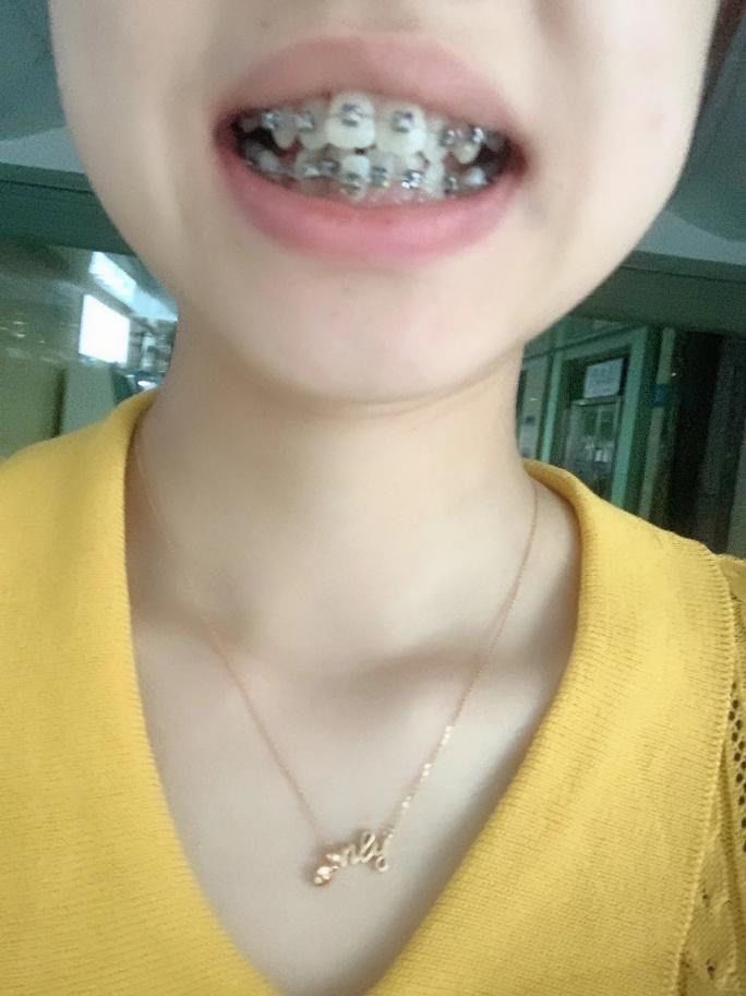 但是因为太疼了就迟迟没去,后来看到好多朋友戴了牙套,才下定决心整牙