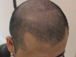 -大麦微针植发全国连锁