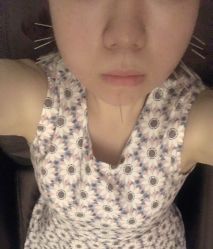 -肥三针腧穴瘦身馆