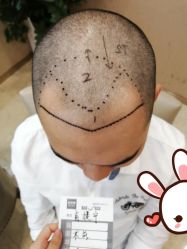 -大麦微针植发丨全国连锁