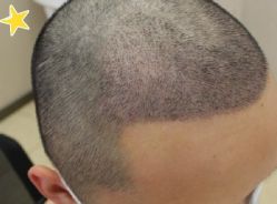 -大麦微针植发丨全国连锁