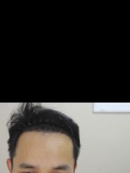 -大麦微针植发全国连锁