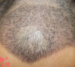 -大麦微针植发丨全国连锁