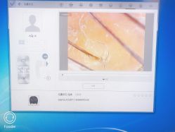 -碧莲盛·不剃发植发