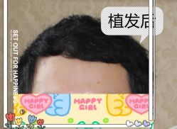 -大麦微针植发全国连锁