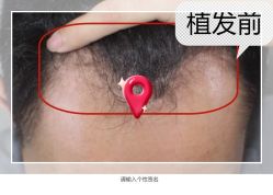 -大麦微针植发全国连锁