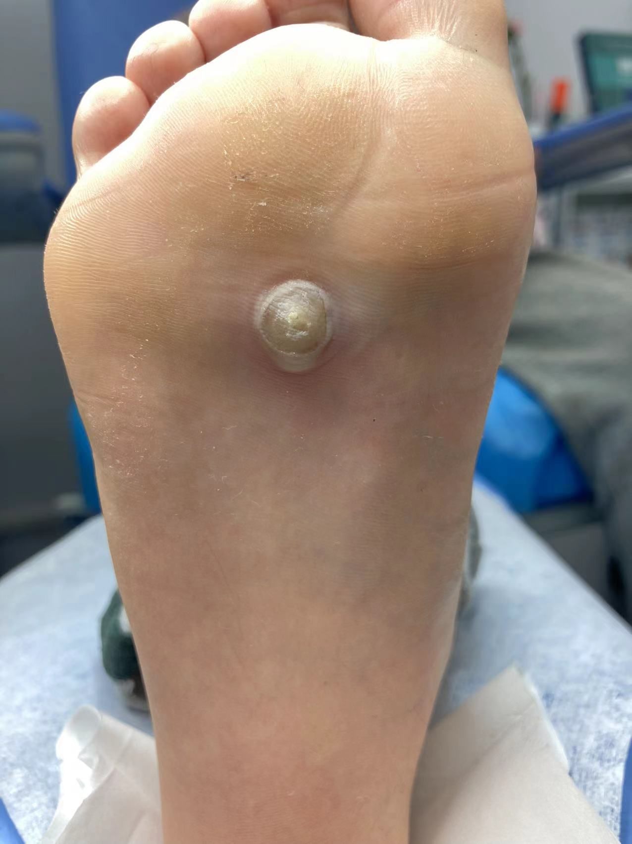 女儿的病毒性跖疣,让我们忧心忡忡.幸得朋