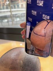 -碧莲盛·不剃发植发