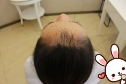 点击看大图 -大麦微针植发丨全国连锁