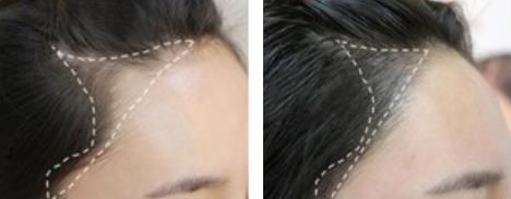 -大麦微针植发全国连锁