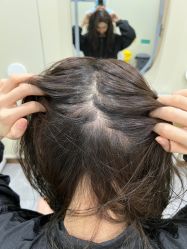 -碧莲盛·不剃发植发