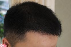 -大麦微针植发丨全国连锁