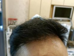 点击看大图 -大麦微针植发丨全国连锁