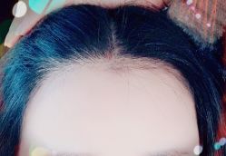 -大麦微针植发全国连锁