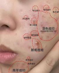 -瑶芳清颜草本祛痘