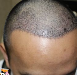 -大麦微针植发丨全国连锁