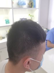 -大麦微针植发丨全国连锁